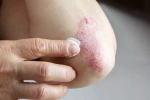 Skin disorders news, Skin disorders, five common skin disorders and their symptoms, Allergies