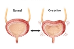 Overactive Bladder, Overactive Bladder disadvantages, here are some warning signs of an overactive bladder, Overactive bladder