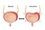 Overactive Bladder foods, Overactive Bladder signs, here are some warning signs of an overactive bladder, Tv and obesity