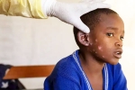 Monkeypox Outbreak news, Mpox, is monkeypox outbreak coming to india, State governments