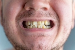 Nicotine stains good for health, Nicotine stains latest, are nicotine stains on your teeth irreversible, Nicotine