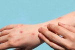 Monkeypox symptoms, Monkeypox in bisexual men, study says that the symptoms of monkeypox are different from earlier, Monk