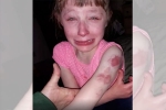 school bus, bite marks, 10 year old special needs child brutally bitten on arm while returning home in school bus, Special needs