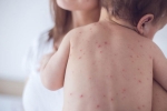 measles in US, measles in adults, measles back in the united states as children omit vaccination doses, Toddler