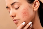 skin, pimples, 10 ways to get rid of pimples at home, Unsc