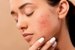 home remedies, pimples, 10 ways to get rid of pimples at home, Natural glow